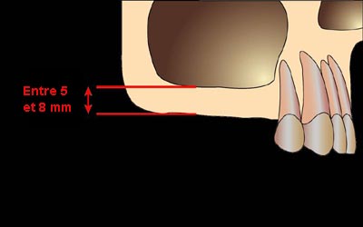 sinus-lift