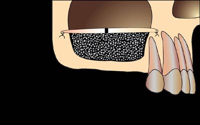 sinus-lift