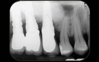 sinus-lift