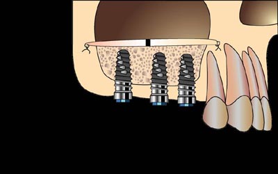 sinus-lift