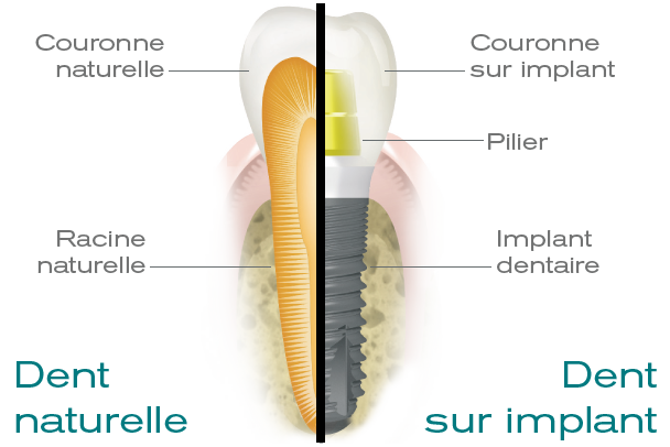 implant dentaire