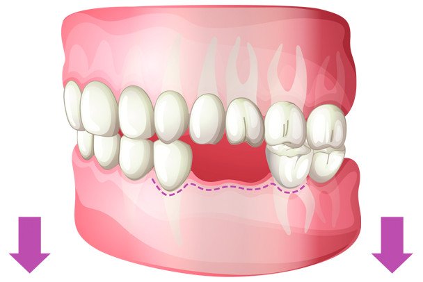 pourquoi remplacer les dents ?