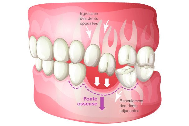 pourquoi remplacer les dents ?