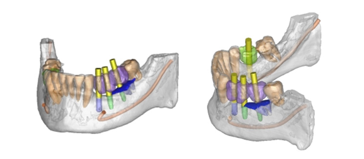 simulation implantaire