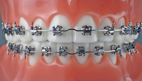 orthodontie ado 1