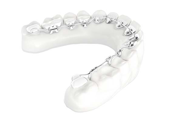 orthodontie adulte 2