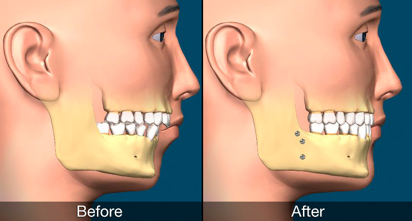 orthodontie adulte 4