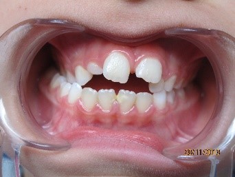 orthodontie enfant 4