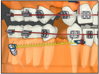 minivis orthodontique