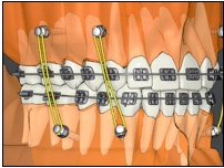 minivis orthodontique