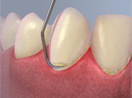 dental scaling